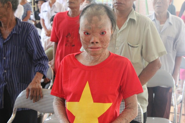 Thái Bình: Tết trung thu tại Bệnh viện Phong – Da liễu Văn Môn